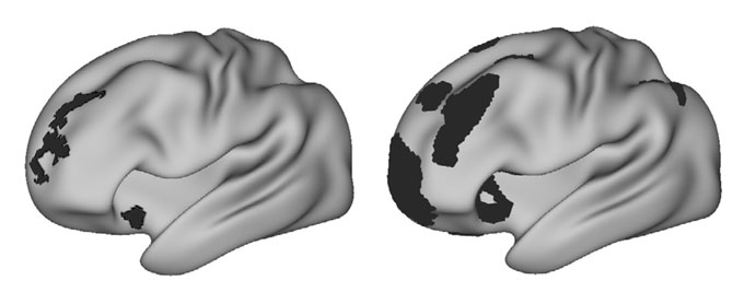 Two brains are shown in gray from the side. The one on the left has black spots in some areas, while the one on the right has larger black spots in similar regions.